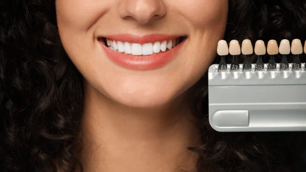dental veneers in Estepona