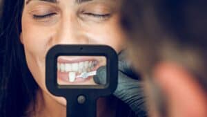dental veneers in Estepona