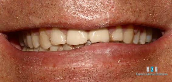 carillas-dentales-antes-09