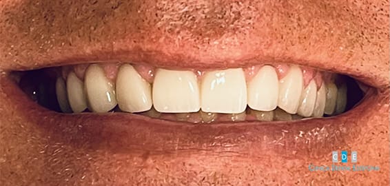 carillas-dentales-despues-09