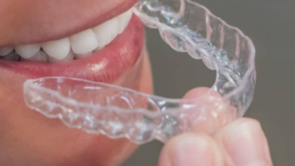 Invisalign vs Brackets