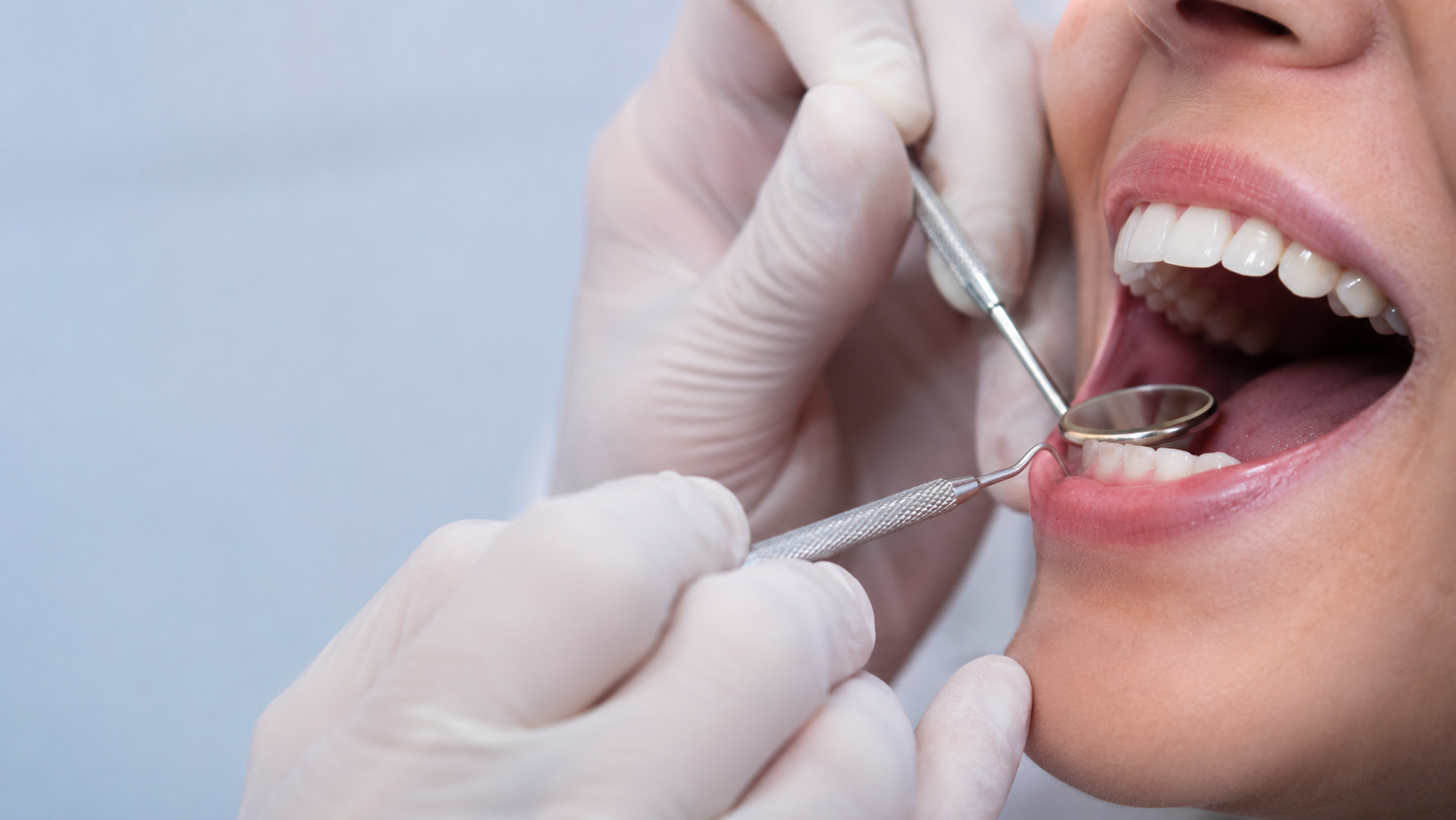 limpieza dental en Estepona